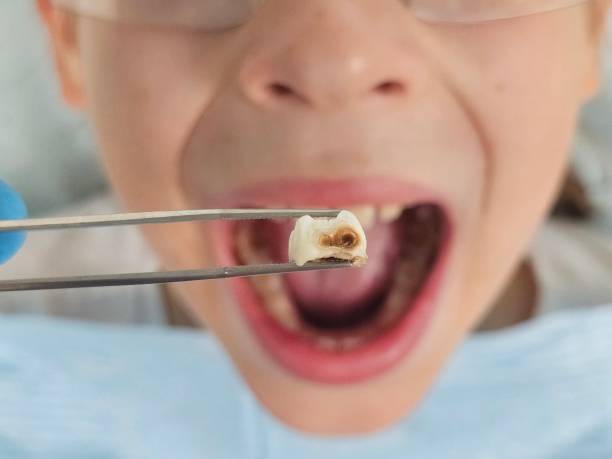 Best Emergency Dental Care for Abscessed Tooth in Dallas, GA